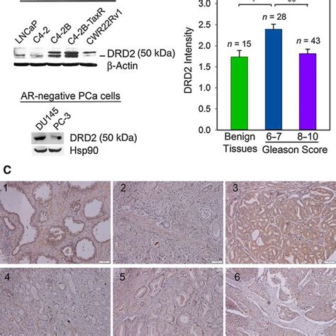 Expression Of DRD2 In Human Prostate Cancer PCa Cell Lines And