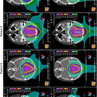 Transverse Planar Dose Distributions At The Isocenters In The Four