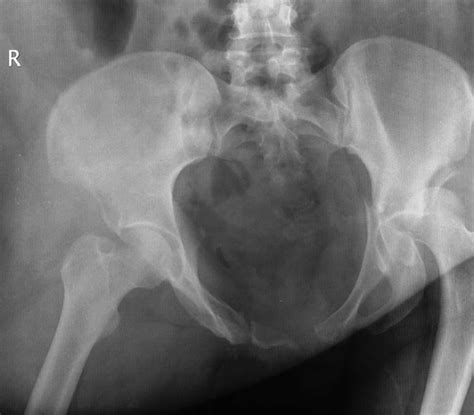 AP Pelvis Radiograph Demonstrating Type II Anteroposterior Compression