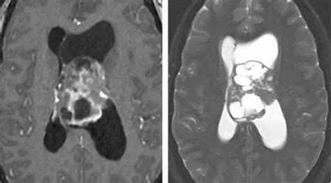 脑室内肿瘤手术策略与技巧 The Neurosurgical Atlas全文翻译 脑医汇 神外资讯 神介资讯