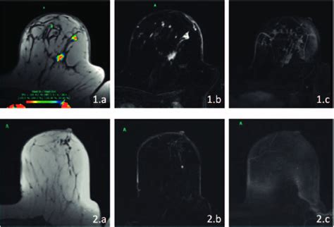 Dynamic Contrast Enhanced Magnetic Resonance Imaging DCE MRI