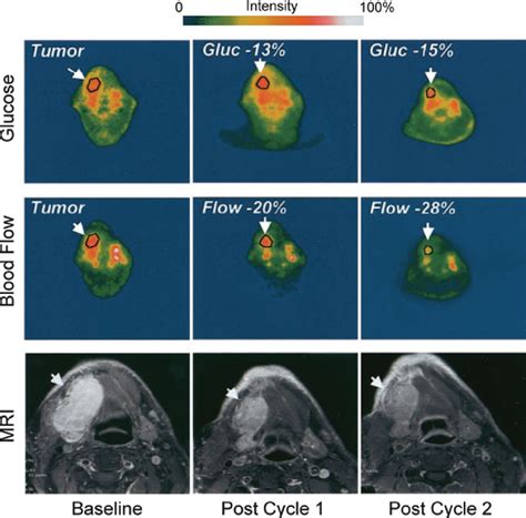 Pet Scans Before And After Antiangiogenic Treatment With Human