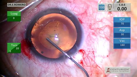 Hydrodissection And Hydrodelamination In Cataract Surgery Youtube