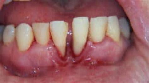 Advanced Periodontal Disease Before And After