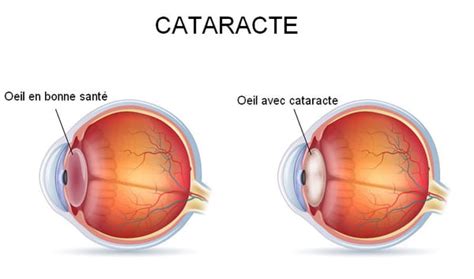 Cataracte D Finition Causes Sympt Mes Quel Ge