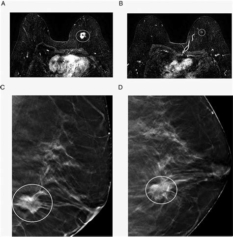 Assessment Of Mri Detected Lesions On Screening Tomosynthesis In