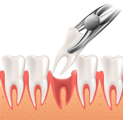 Tooth Extraction Home Care Instructions Cobblestone Dental Care