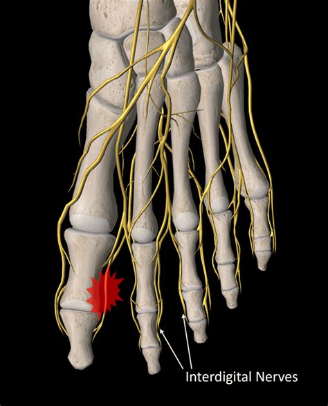 What Is A Mortons Neuroma Regenexx