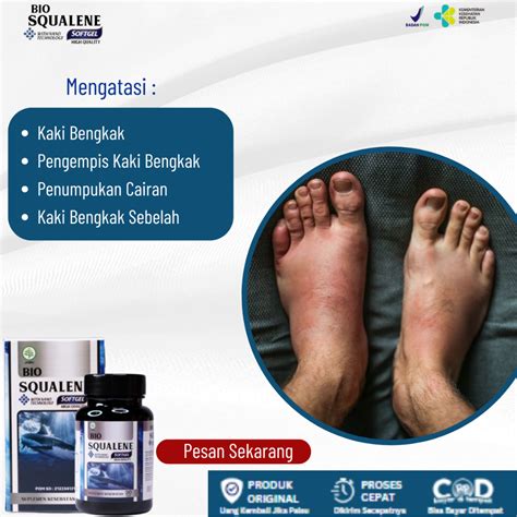 Jual Obat Kaki Bengkak Obat Penumpukan Cairan Obat Pengempes Kaki