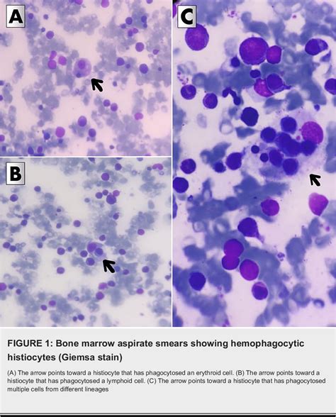 Figure 1 From Hemophagocytic Lymphohistiocytosis With Obstructive