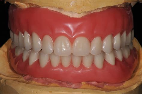 Full Dentures - Art Dental Lab