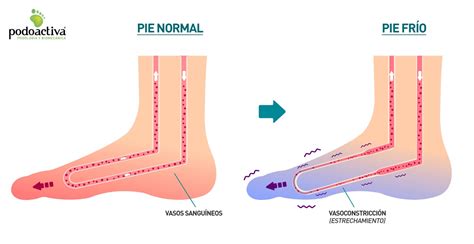 Pies Fr Os Debo Preocuparme Causas Recomendaciones Y Lesiones M S