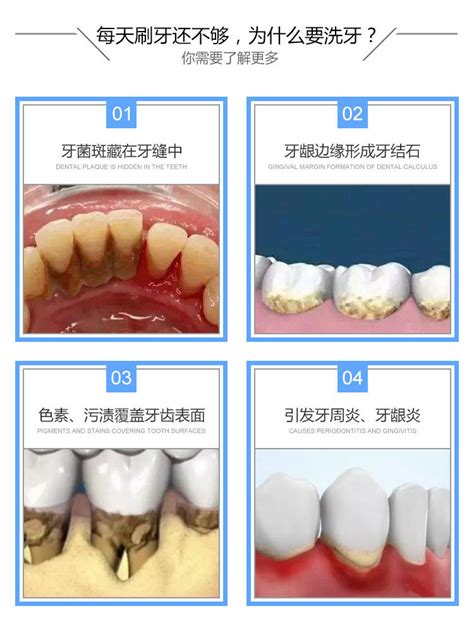 牙菌斑如何去除牙菌斑多要不要洗牙？牙齿
