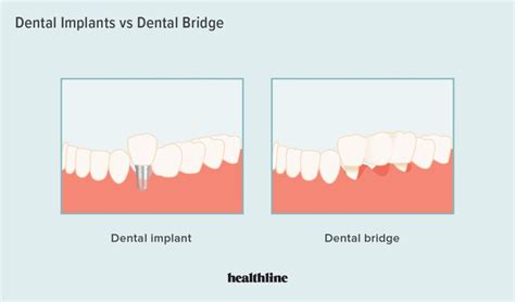 Dental Implant Vs Bridge Pros Cons And Which To Choose