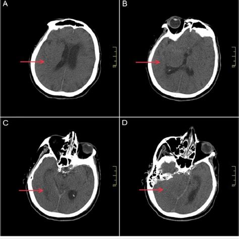 Head Ct Showing Cerebral Edema A B D Red Arrows Show Diffuse Loss Of Download Scientific