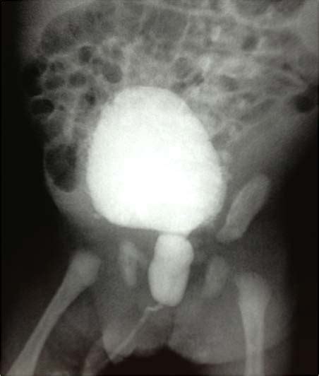 Voiding Cystourethrography Confirming Puv Download Scientific Diagram