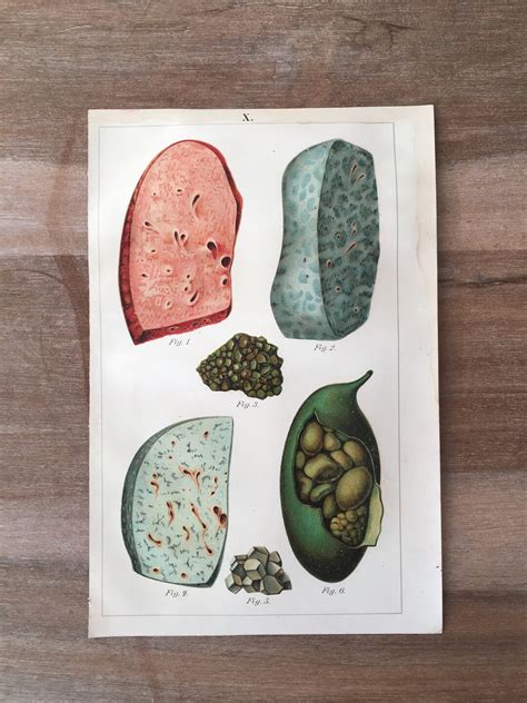 Original Antique Lithograph With Lung And Gall Bladder Diseases