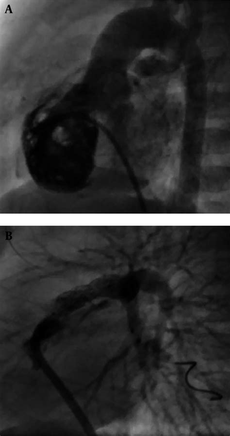 A Severe Infundibular Stenosis LAT RV Injection With RVH B