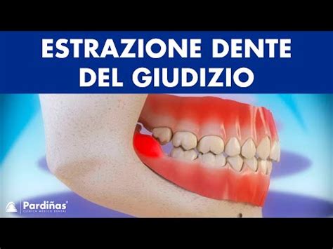 Rimedi Efficaci Per Il Dolore Alle Gengive Causato Dai Denti Del