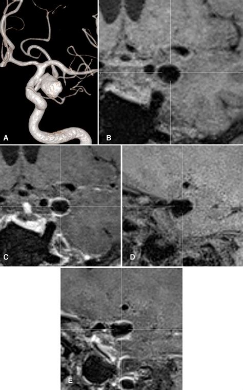 Vessel Wall Imaging In Intracranial Aneurysms Journal Of