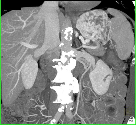 Carcinoma Tail Of Pancreas Extends Into The Splenic Hilum Pancreas