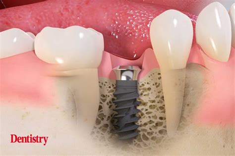 Tissue Level Implants What Are The Benefits Dentistry