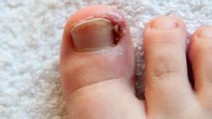 Ingrown Toenail Well Heeled Podiatry Hampton Melbourne