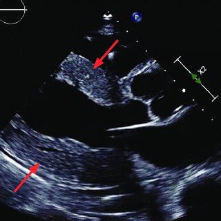 Parasternal long-axis view on echocardiography demonstrates diffuse ...