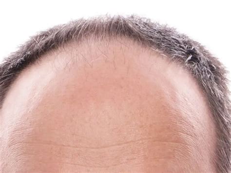 Descubren F Rmaco Efectivo En El Combate De La Alopecia