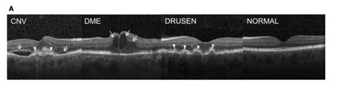 Detecting Retina Damage from OCT-Retinal Images - Towards Data Science