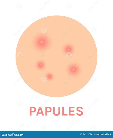 Papules Acne On The Skin Dermatological And Cosmetic Diseases On The