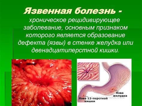 Язвенная болезнь желудка и двенадцатиперстной кишки - презентация онлайн
