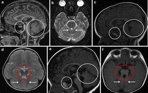 Normal Pituitary Mri T2