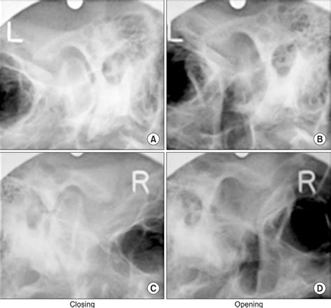 Figure 2 From Synovial Chondromatosis In Temporomandibular Joint