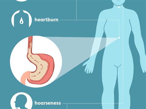 Infos Kesehatan Can You Get Acid Reflux In Your Lungs