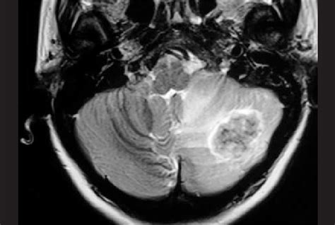 Axial T2 Weighted View Of The Mri Showing The Lesion In The Cerebellum Download Scientific