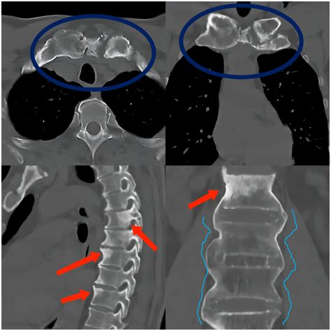 Sapho综合征 中国医学影像联盟 China Medical Imaging Association