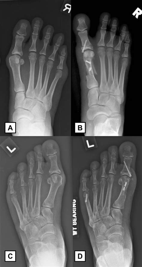 Clinical Outcomes Of Scarf Akin Osteotomy For Hallux Valgus With