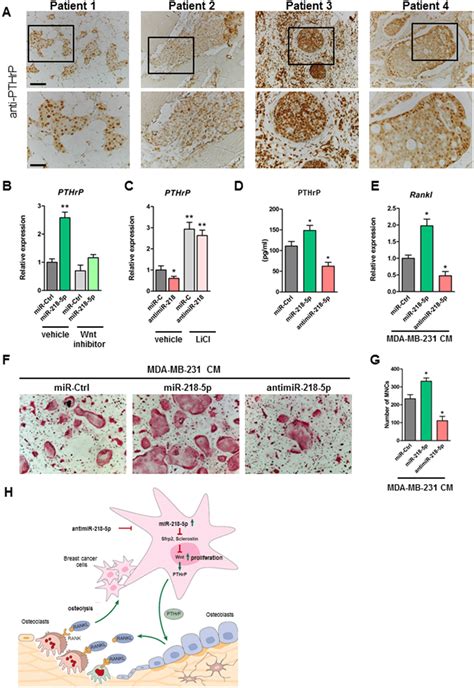 Inhibition Of Mir P In Breast Cancer Cells Decreases Pthrp