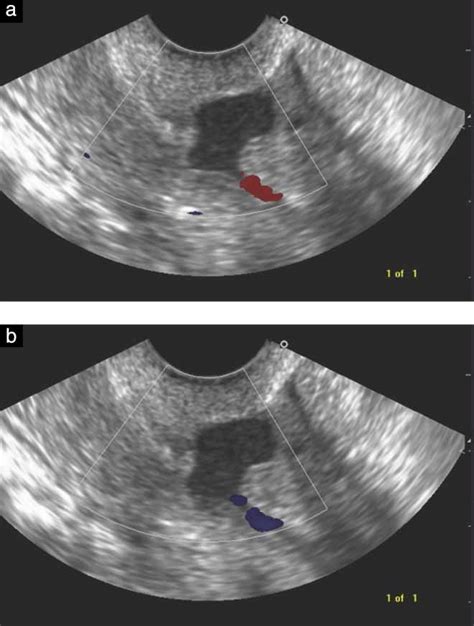 Assessment Of Cesarean Section Scars With Transvaginal Sonography