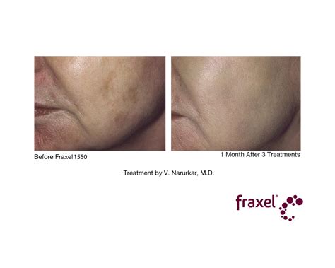 Fraxel Laser Treatment Cost Results Studiomd Midtown Manhattan Nyc