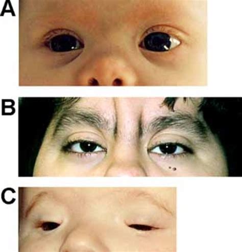 Jacobsen syndrome: MedlinePlus Genetics