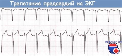 Причины трепетания предсердий