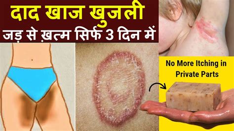 4 Best Home Remedies For Itching Problem In Private Parts Fungal Skin Infection Youtube