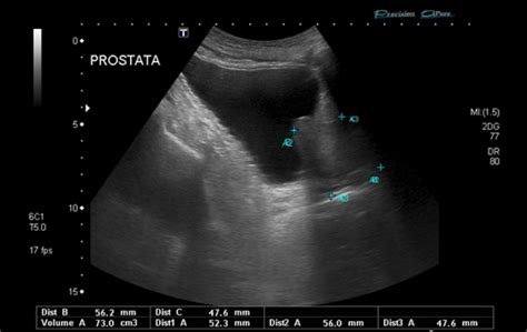 Ultrassonografia De Próstata Dk Urologistas