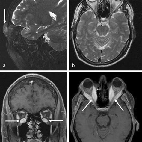 (PDF) Diagnosis and differential diagnosis of Graves' orbitopathy in MRI