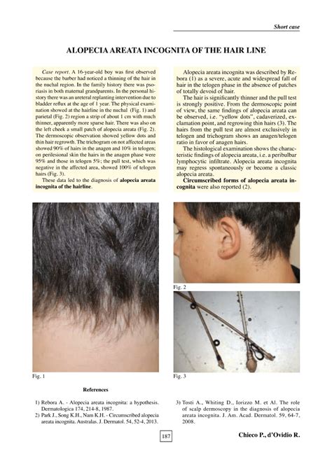 Pdf Alopecia Areata Incognita Of The Hair Line