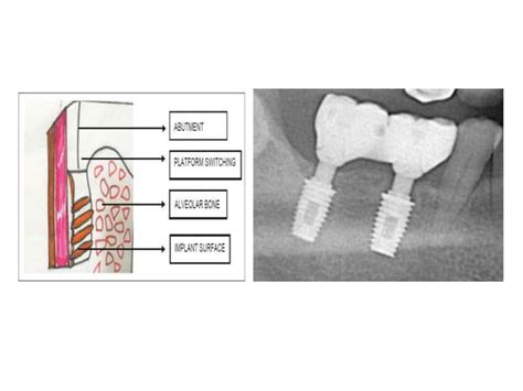 Different Implant Abutment Connections Ppt