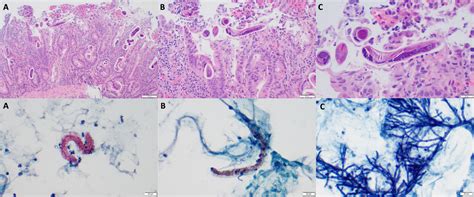 Persistent Clostridium Difficile Colitis Mimicking A Fatal Case Of Strongyloides Hyperinfection