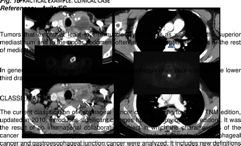 Figure 2 From Esophageal Cancer Anatomical Features Current